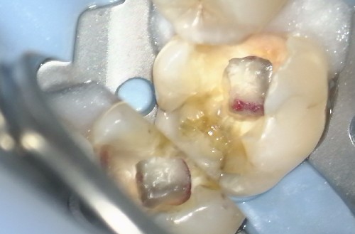 Cracked Tooth Treatment - Treatments Involving Root Canal